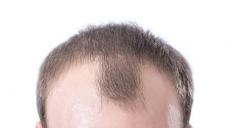 What causes a receding hairline