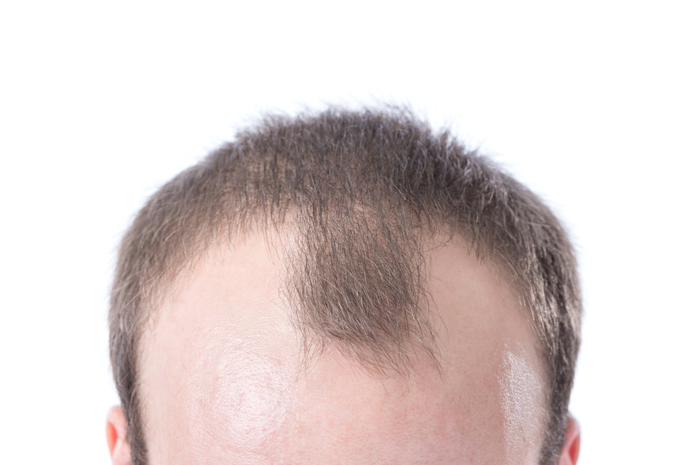What causes a receding hairline